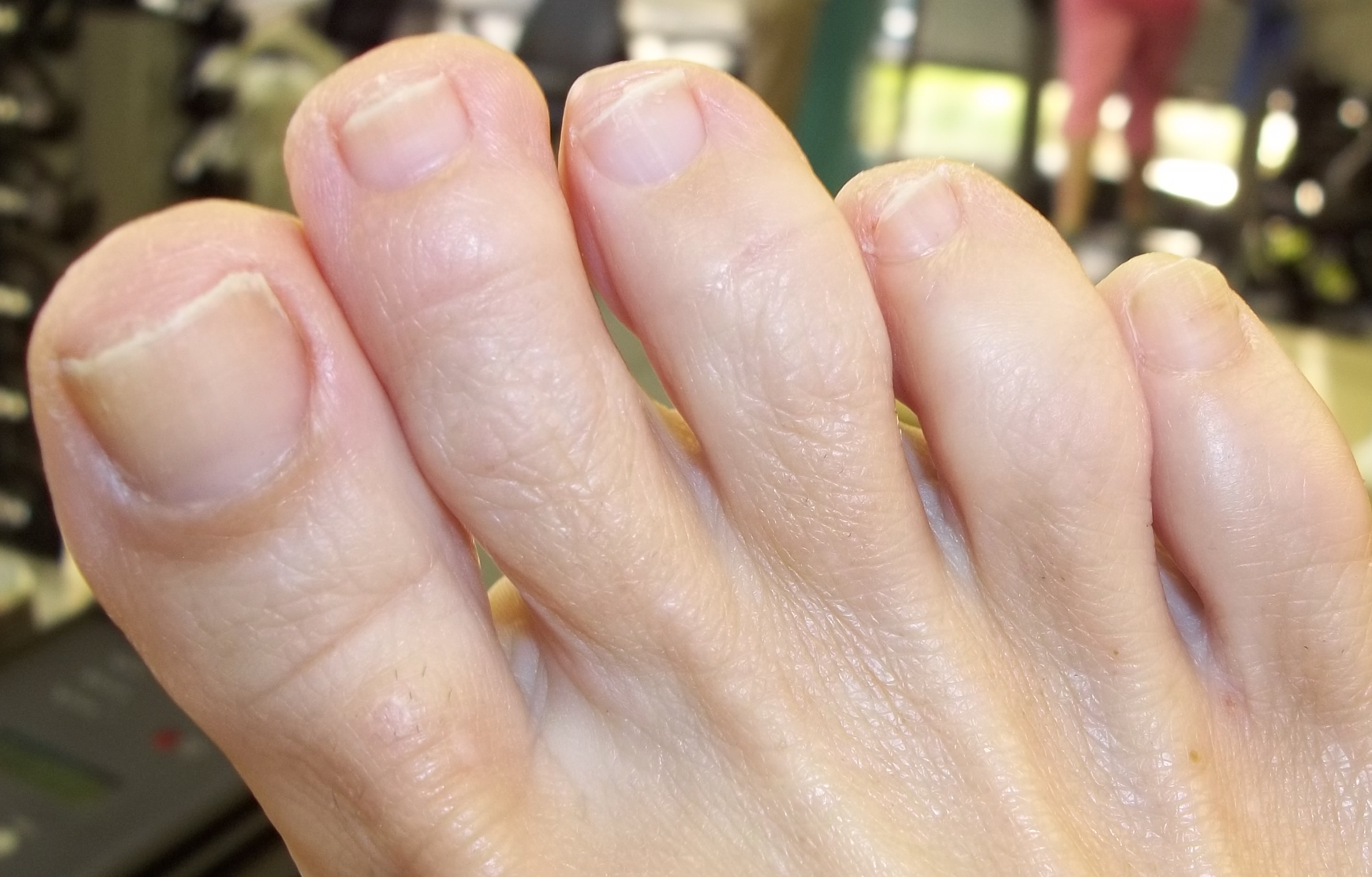 Toe Fungus After Cold Laser Therapy, Toes Look Much Better