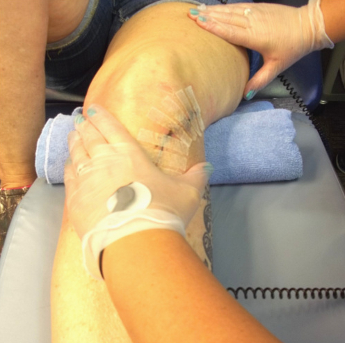 Hivamat Being Used on Patient Knee