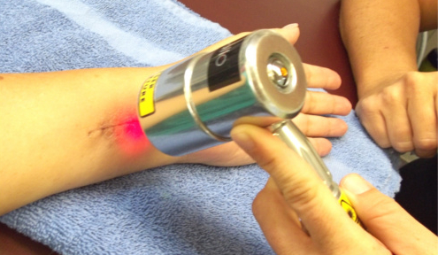Cold Laser Being Used To Treat Scar/Incision on Wrist
